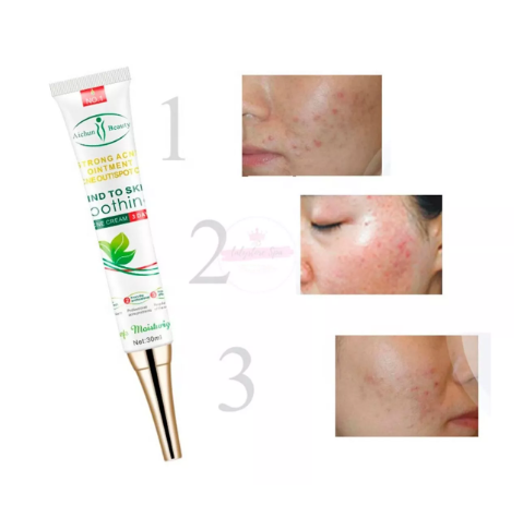 Gel Elimina Acne
